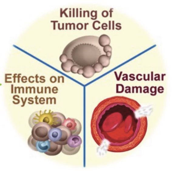 The Emerging High-Power Laser Therapy in Caner Treatment: A Potential Game Changer? 